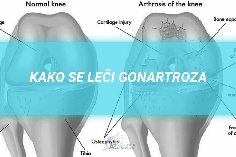 Read more about the article GONARTROZA – Šta je i kako se leči?